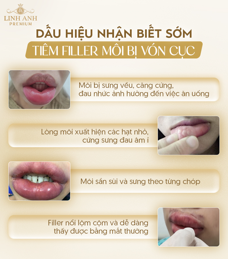 Dấu hiệu filler bị vón cục