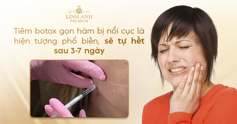 Tiêm botox gọn hàm bị nổi cục