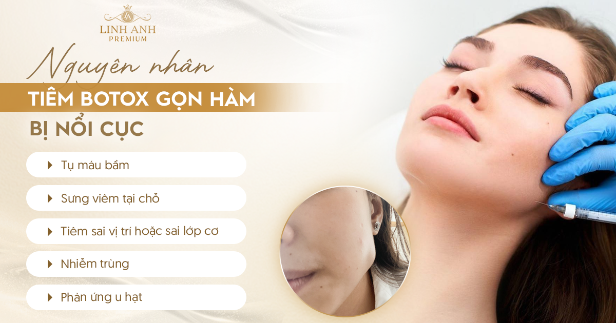 Tiêm botox gọn hàm bị nổi cục Tiêm botox gọn hàm bị nổi cục