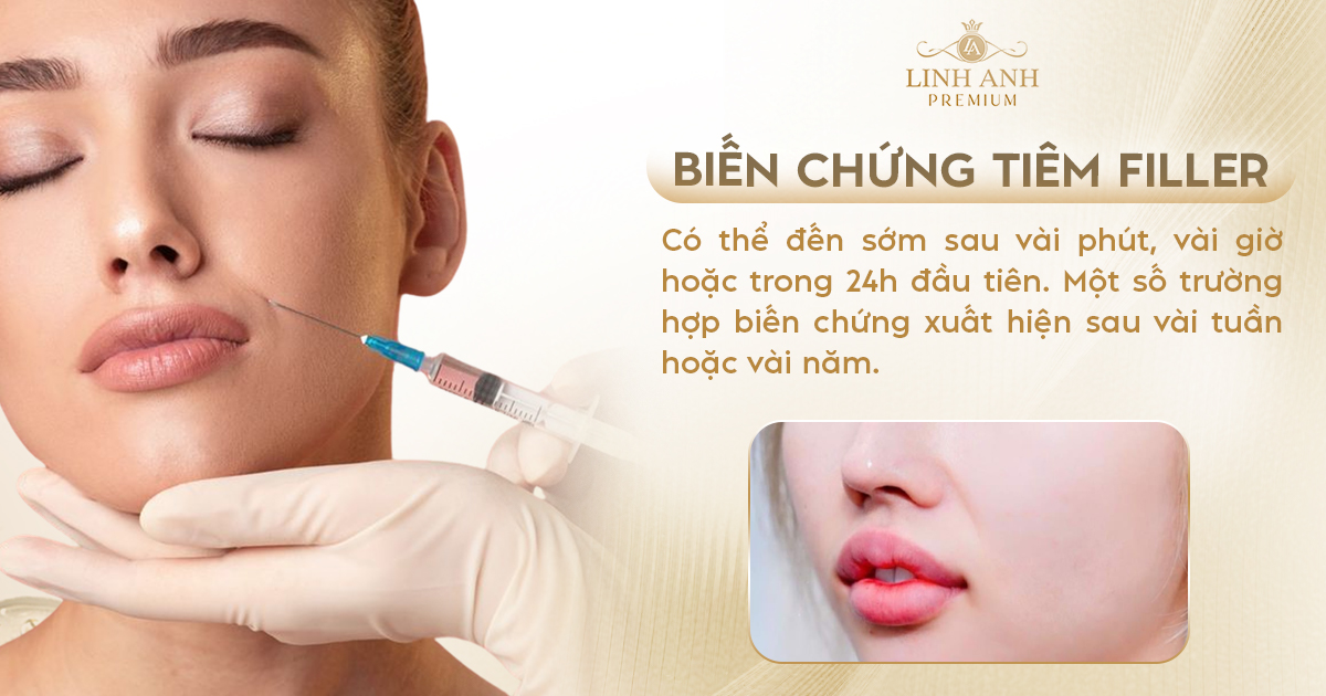Tiêm filler bao lâu thì bị biến chứng