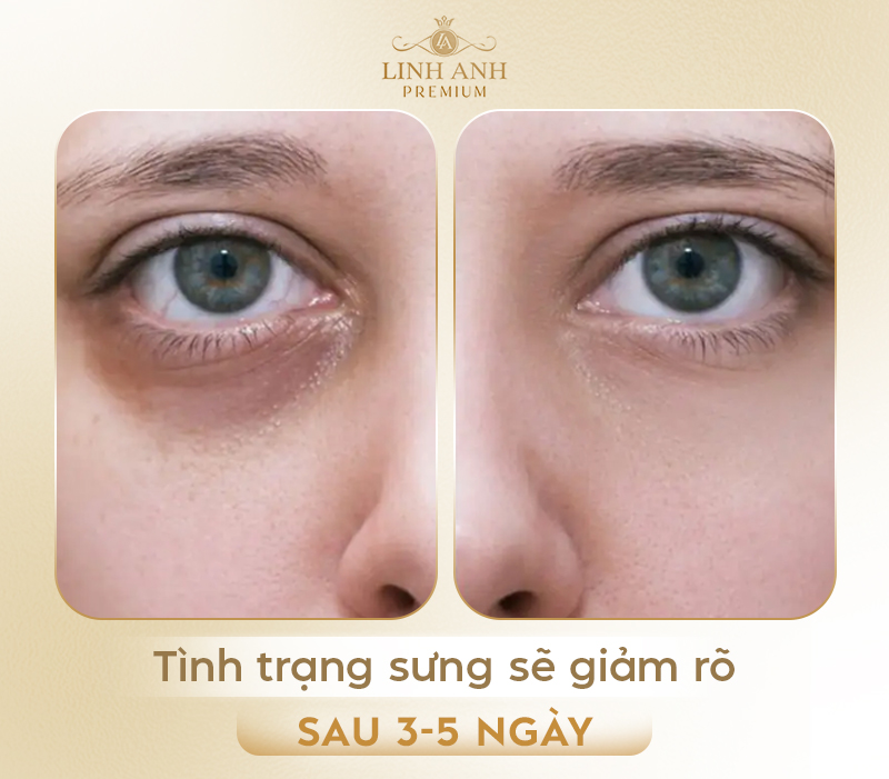 Tiêm filler hốc mắt