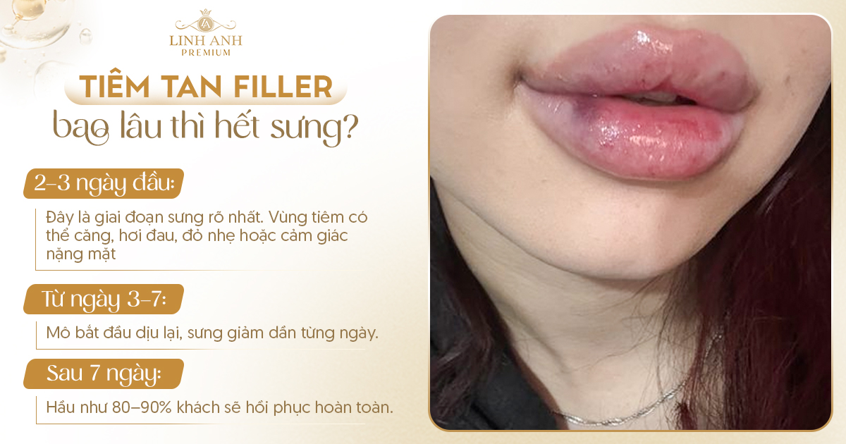 Tiêm tan filler bao lâu thì hết sưng
