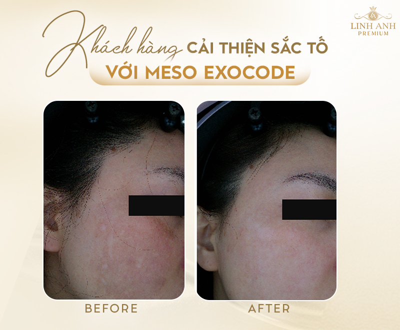 Meso exocode có tác dụng gì