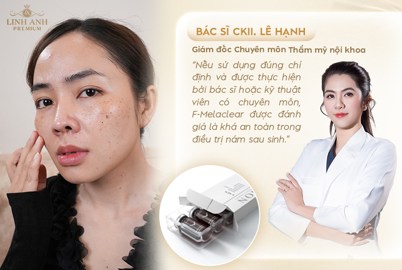 Nám sau sinh có tiêm meso Fusion được không?