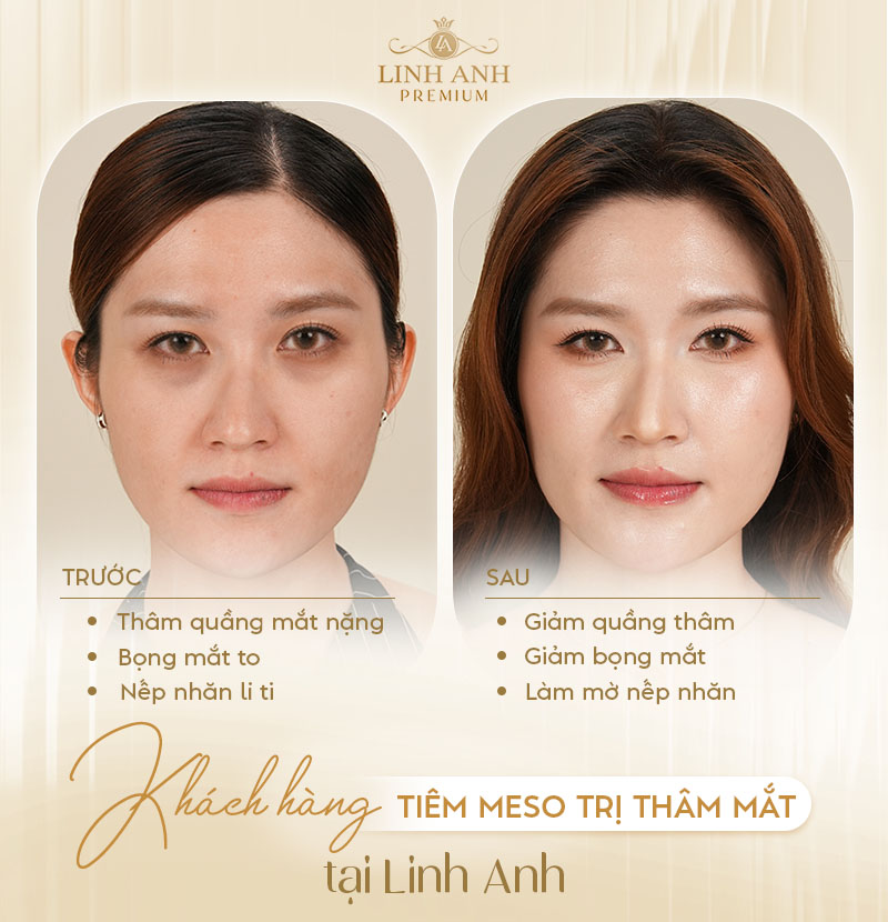 Review Tiêm meso trị thâm mắt Review Tiêm meso trị thâm mắt