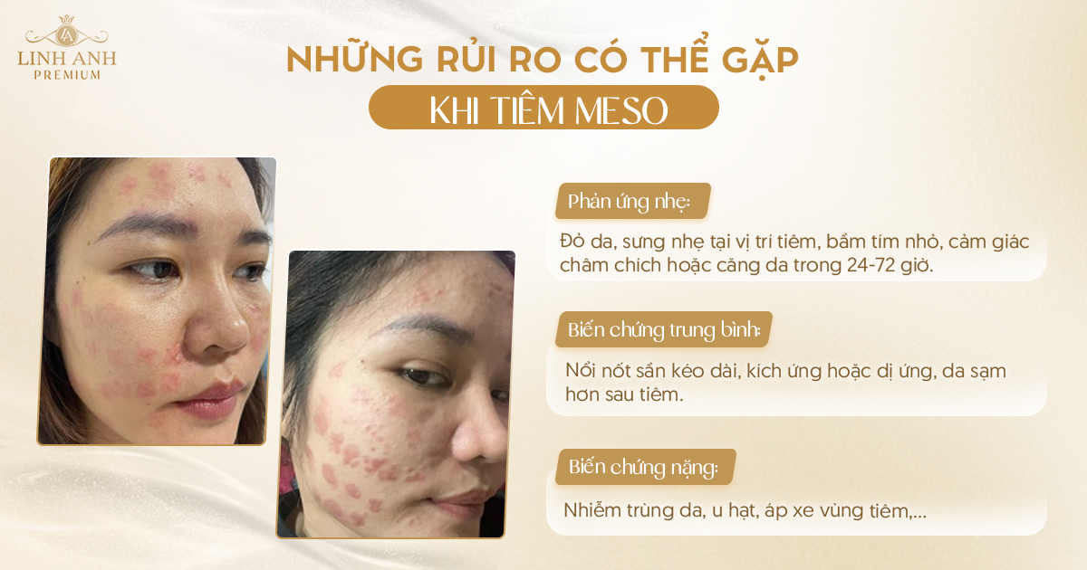 tiêm meso có tác dụng phụ không