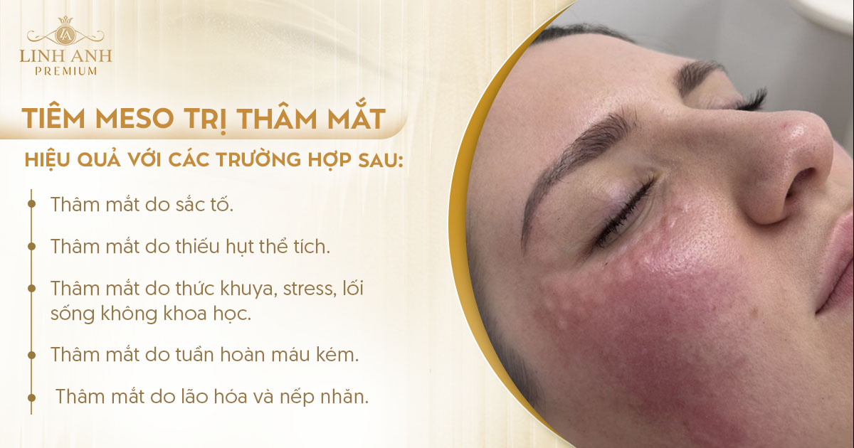Tiêm meso trị thâm mắt có hiệu quả không