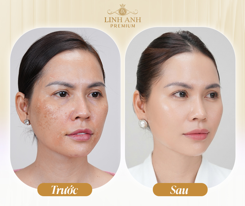 Trước và sau tiêm Karisma